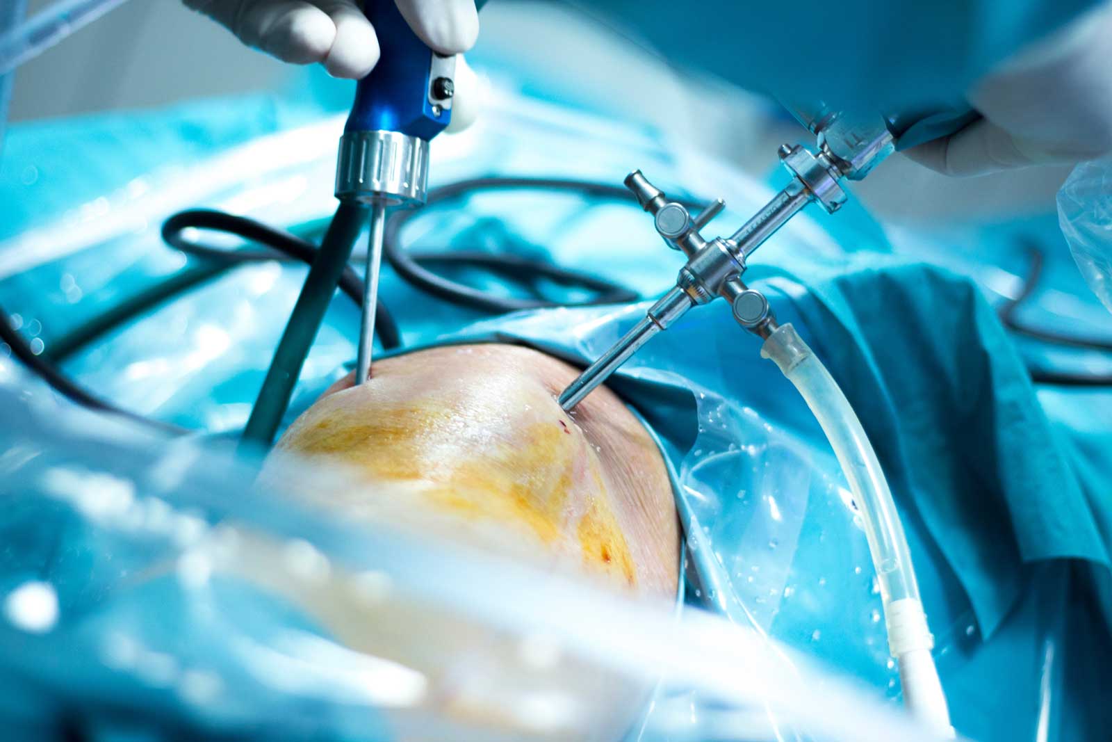 KNEE ARTHROSCOPY Midwest Orthopaedics