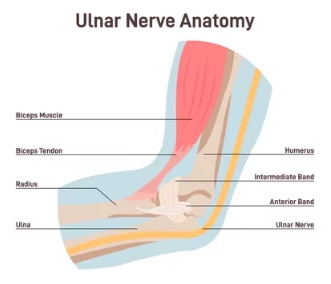 Ulnar nerve entrapment