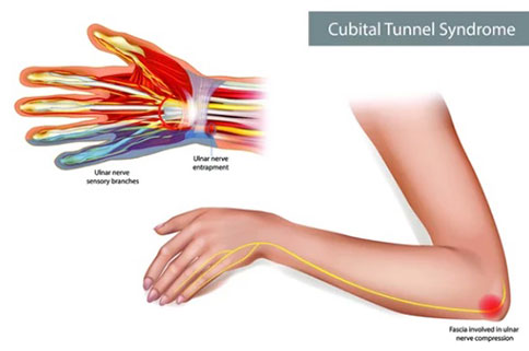 Ulnar nerve entrapment, also known as cubital tunnel syndrome, can cause  several symptoms related to the compression of the ulnar nerve a