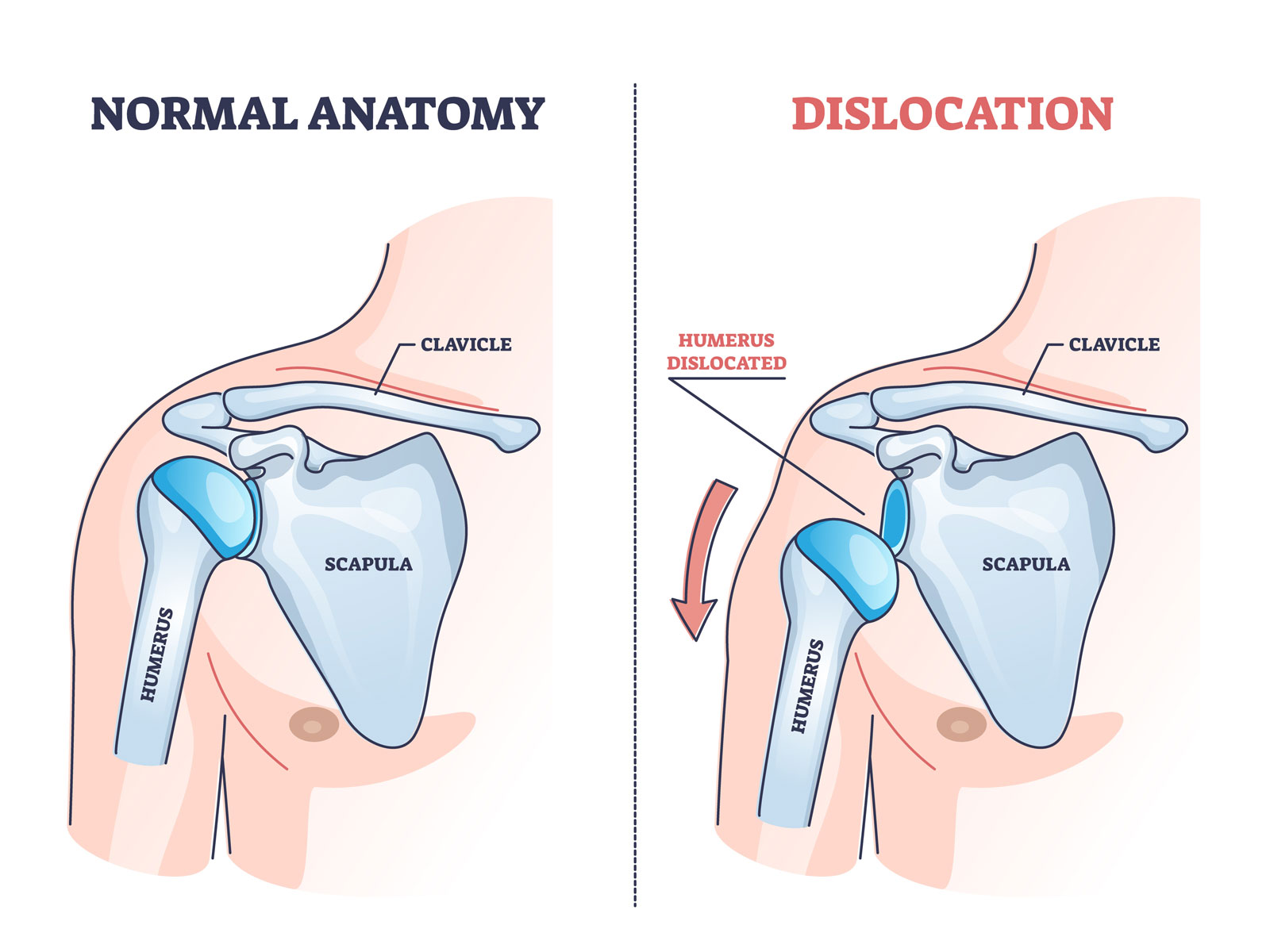 Medical Shoulder Dislocation Injury Arthritis Pain Back Support