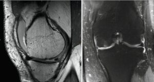 KNEE CARTILAGE INJURIES - Midwest Orthopaedics