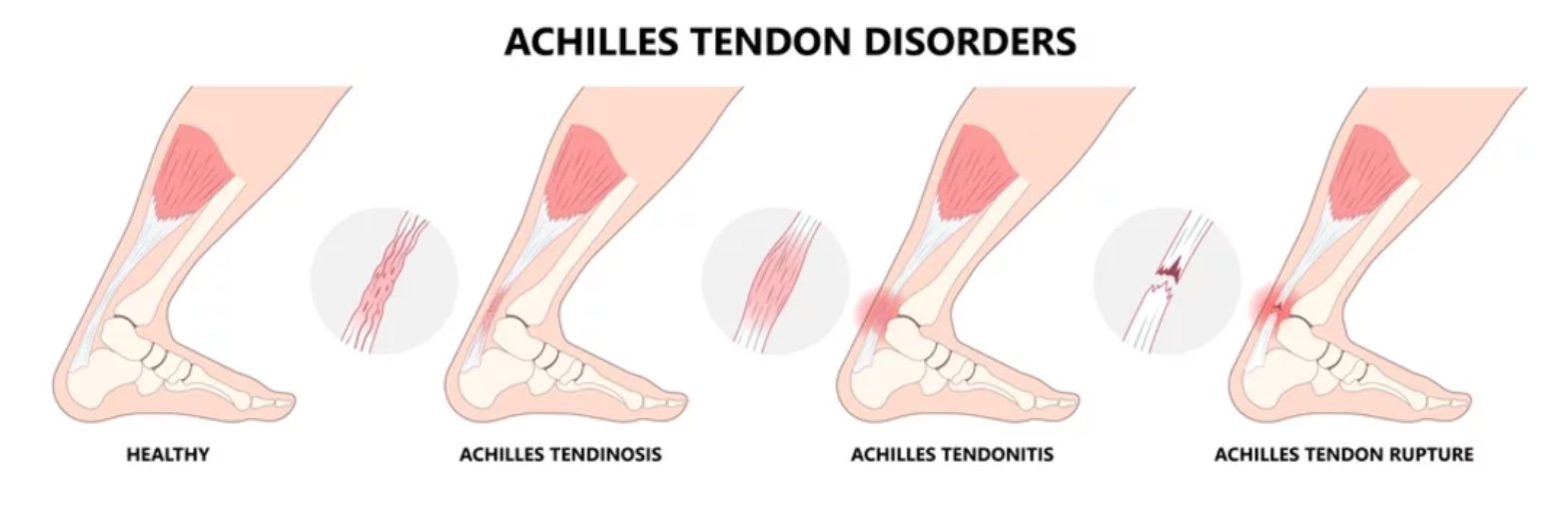 What is an Achilles rupture? What are the symptoms and how long does it  take to recover