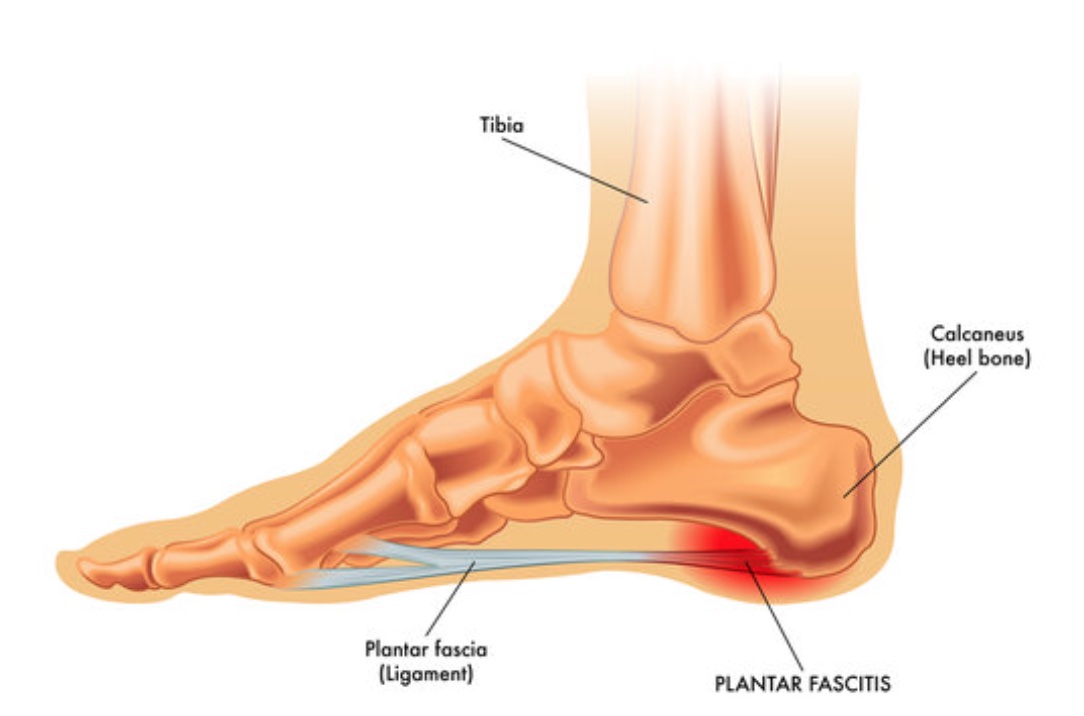 When Heel Pain Is Not Plantar Fasciitis