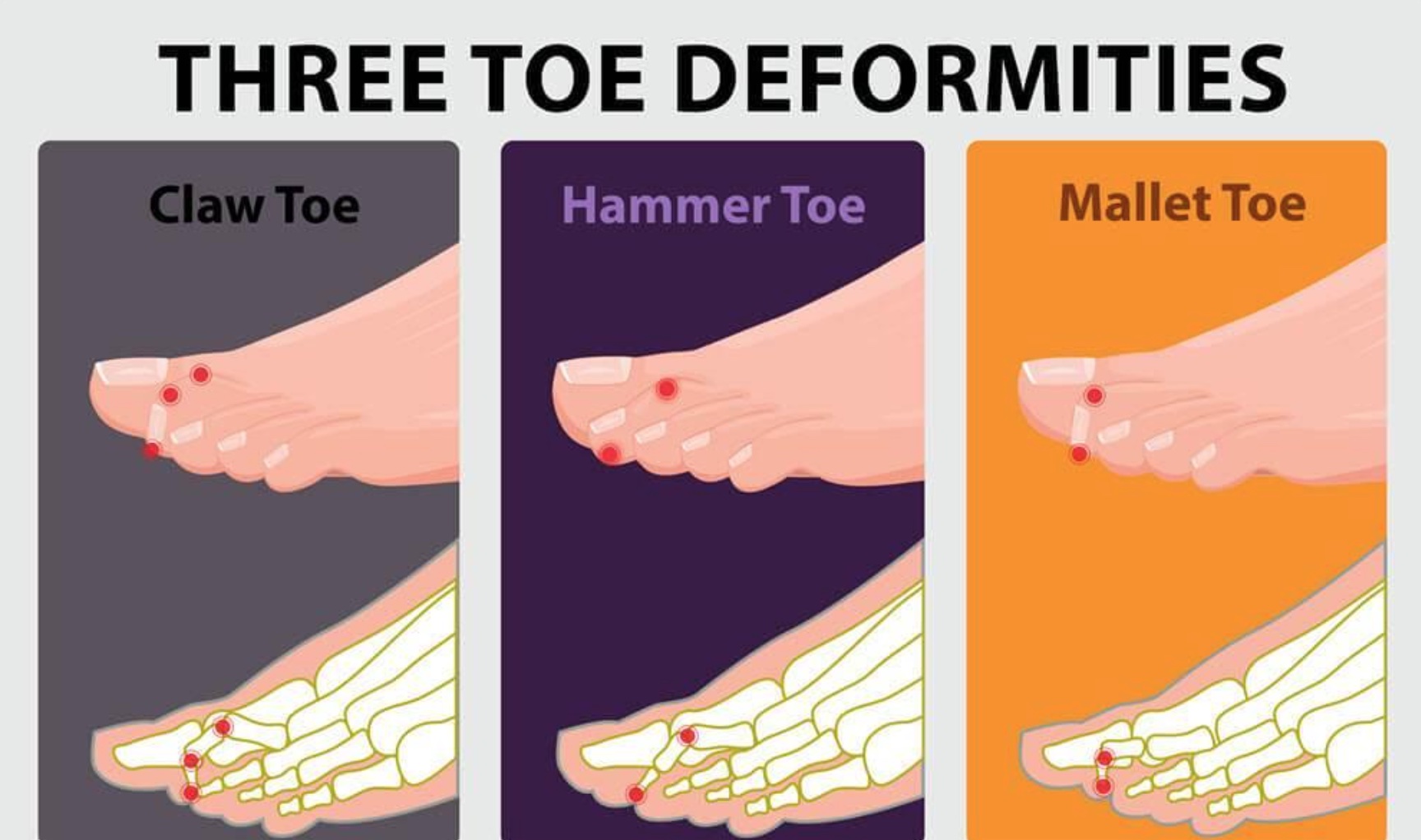 LESSER TOE DEFORMITIES INCLUDING HAMMERTOE - Midwest Orthopaedics